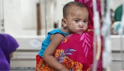 measles